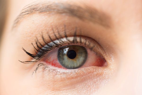 med simptomi suhih oči so rdeče oči